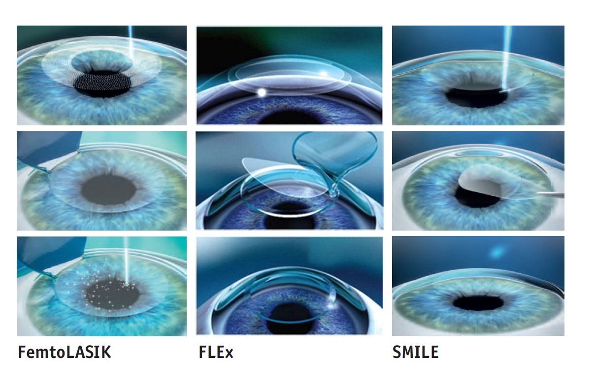 Современные технологии лазерной коррекции нарушений зрения
